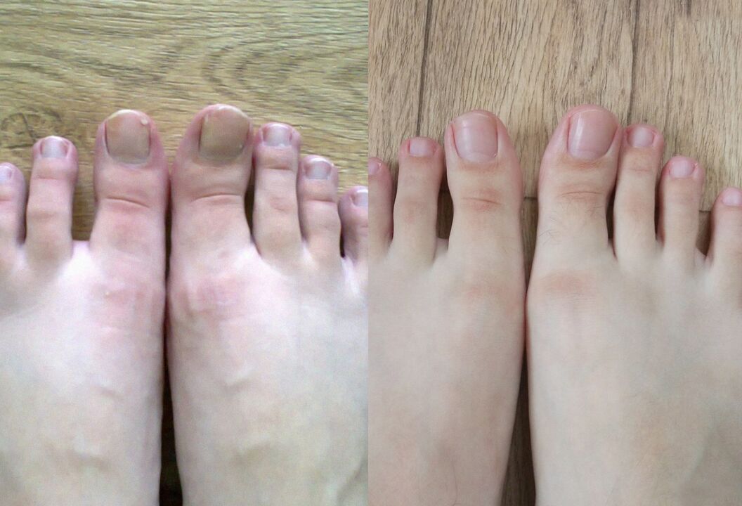 Antes e despois do tratamento a crema de promisil de cogomelos