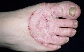 Os motivos da aparición do cogomelo nas pernas