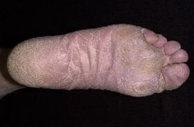 Sinais e síntomas de cogomelos nas pernas