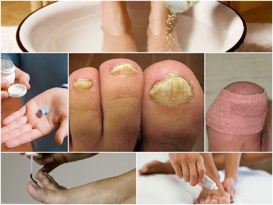 Tratamento do fungo das uñas
