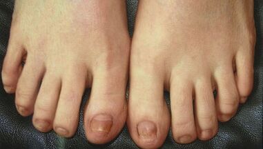 Fases de desenvolvemento do fungo das uñas