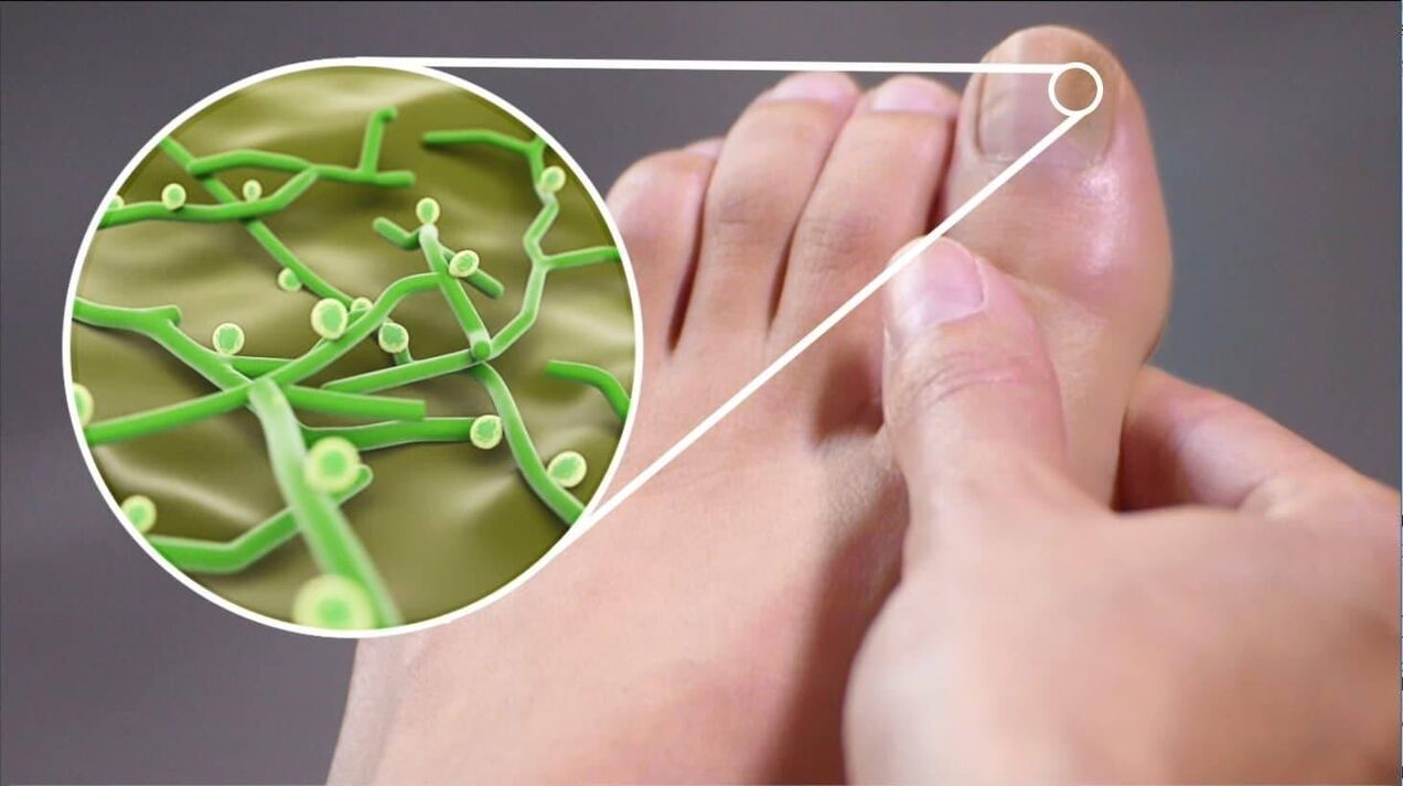 Patóxeno dos fungos da unha