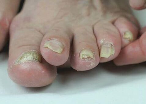 Tratamento de fungos nas unhas con medicamentos