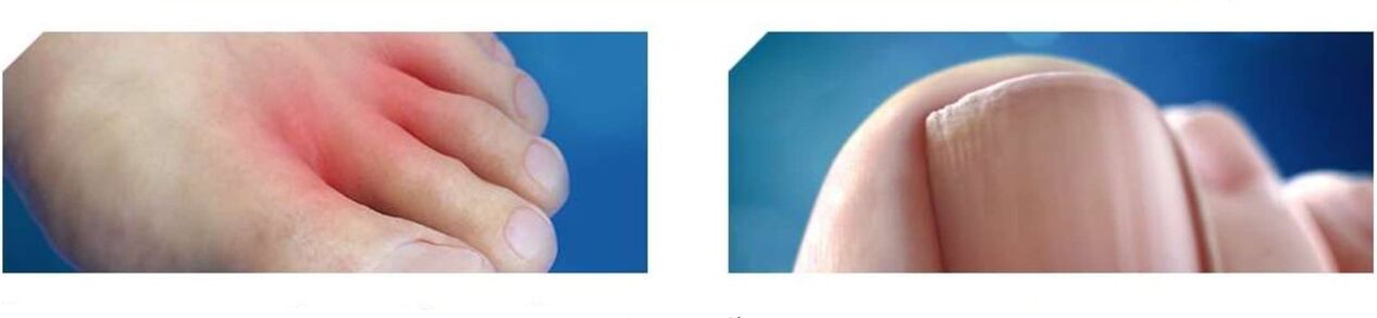 Etapa inicial do pé de atleta