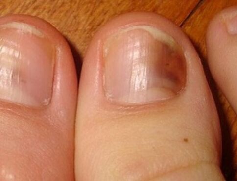 Síntomas de fungo das unhas dos pés